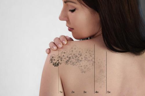 Détatouage : Comment enlever un tatouage par Le Salon à Thiais, Vitry-sur-Seine